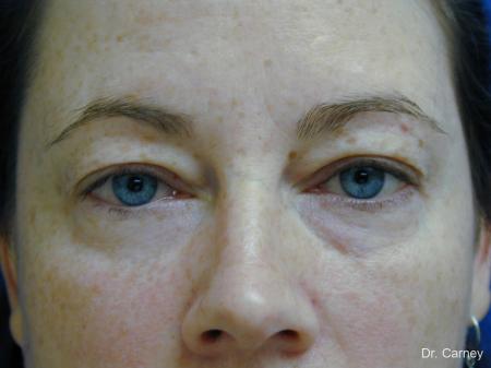Virginia Beach Eyelid Lift 1138 - Before Image 1