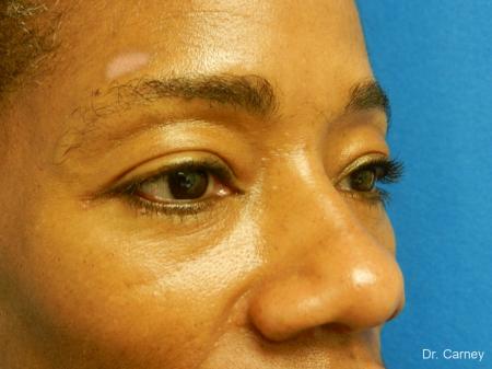 Virginia Beach Eyelid Lift 1130 - After Image 1