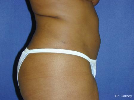 Virginia Beach Liposuction 1283 - After Image 2