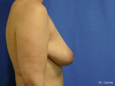 Virginia Beach Breast Lift 1185 - Before and After Image 3