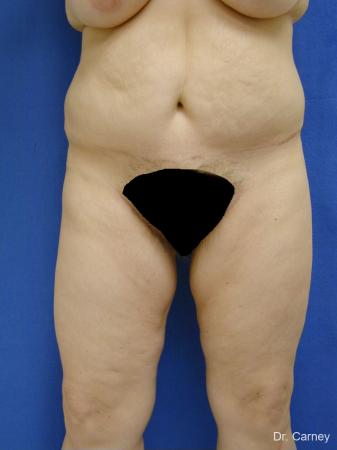 Virginia Beach Thigh Lift 1253 - After Image 1