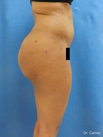 Brazilian Butt Lift: Patient 6 - After Image 5