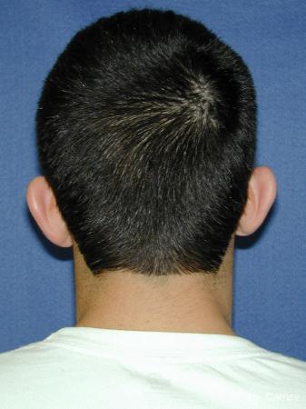 Virginia Beach Otoplasty Earlobe Repair 1222 - Before and After Image 5