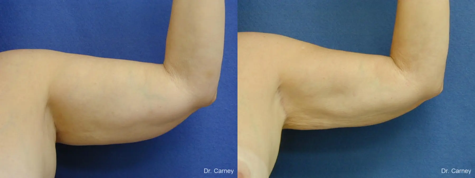 Virginia Beach Brachioplasty 1144 - Before and After 1