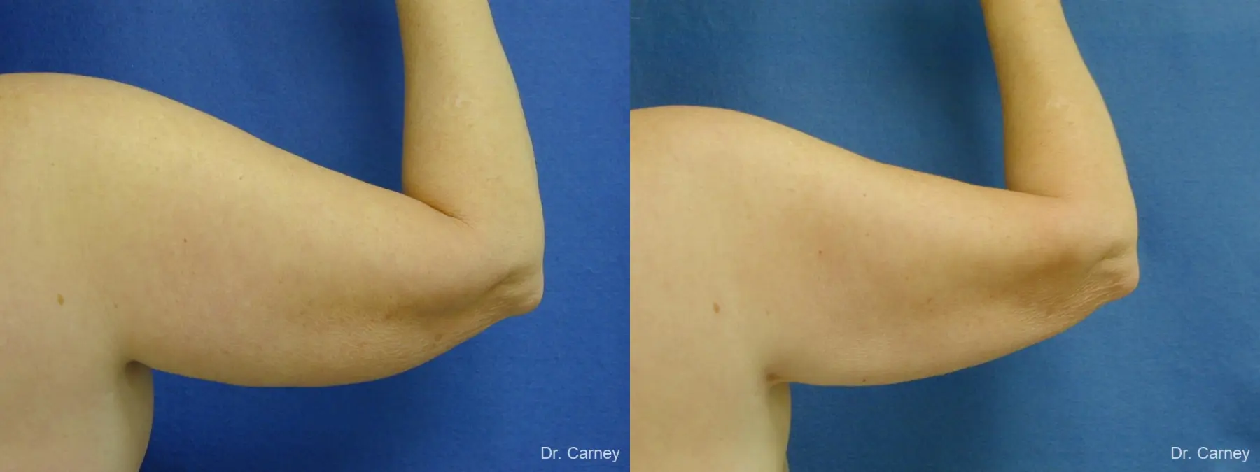 Virginia Beach Brachioplasty 1144 - Before and After 2