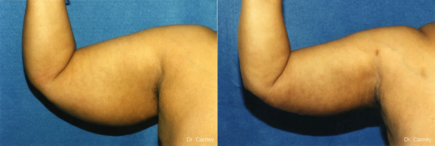 Virginia Beach Brachioplasty 1142 - Before and After