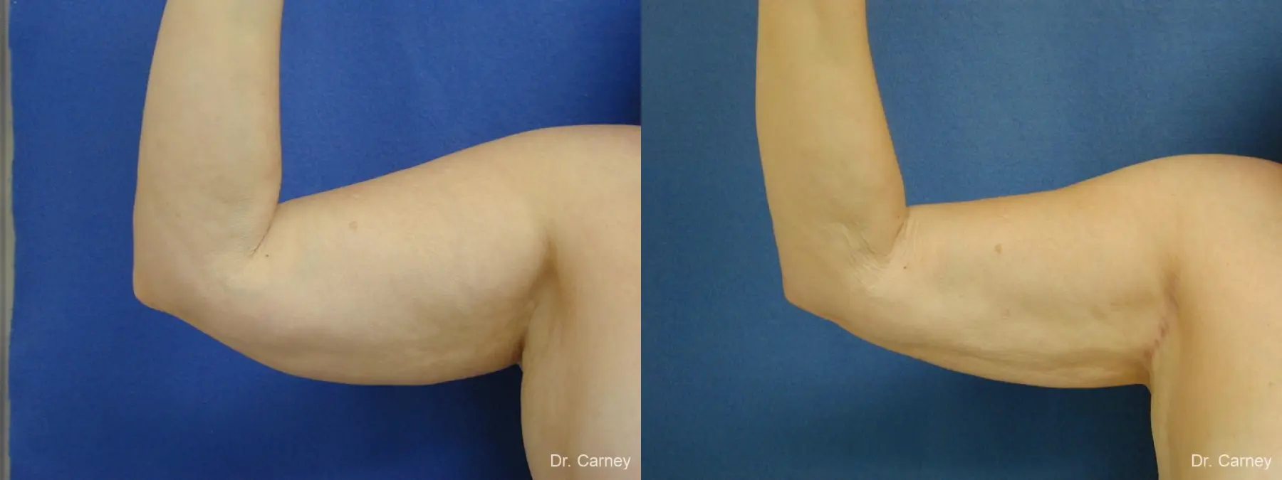 Virginia Beach Brachioplasty 1144 - Before and After 3
