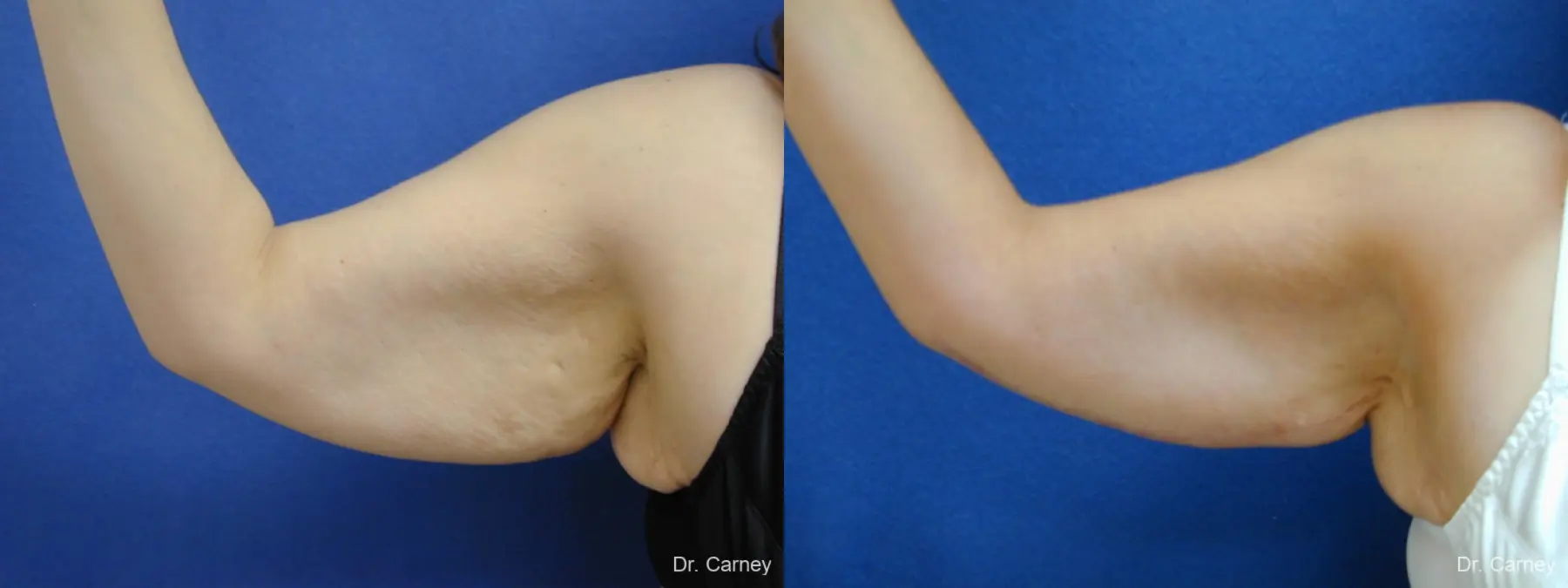 Virginia Beach Brachioplasty 1140 - Before and After