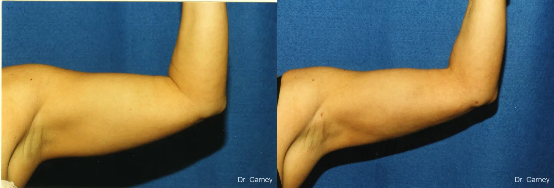 Virginia Beach Brachioplasty 1141 - Before and After 1