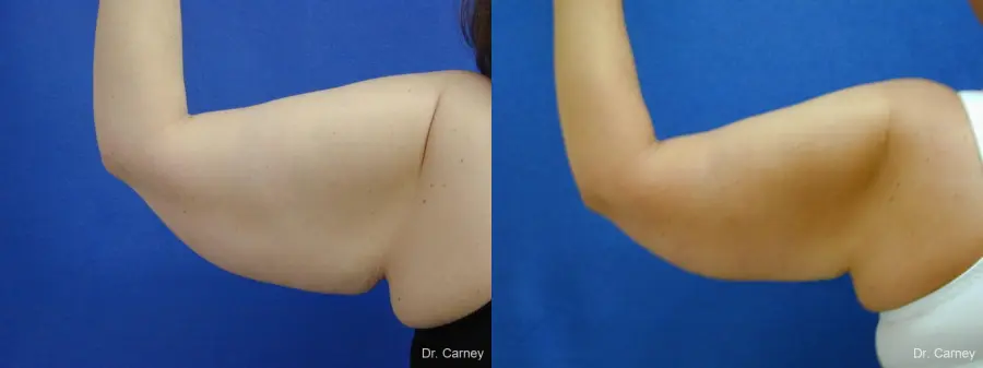 Virginia Beach Brachioplasty 1140 - Before and After 3