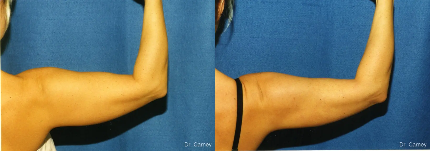 Virginia Beach Brachioplasty 1141 - Before and After 2
