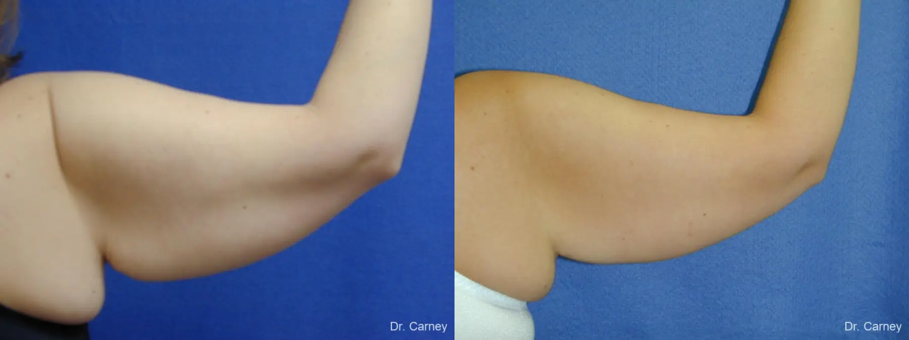 Virginia Beach Brachioplasty 1140 - Before and After 2