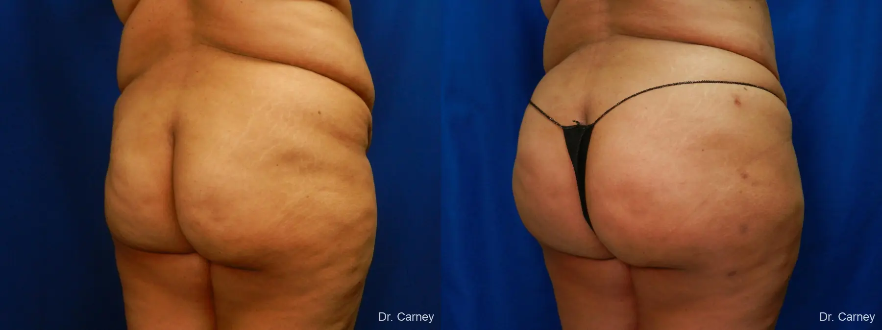 Brazilian Butt Lift: Patient 10 - Before and After 3