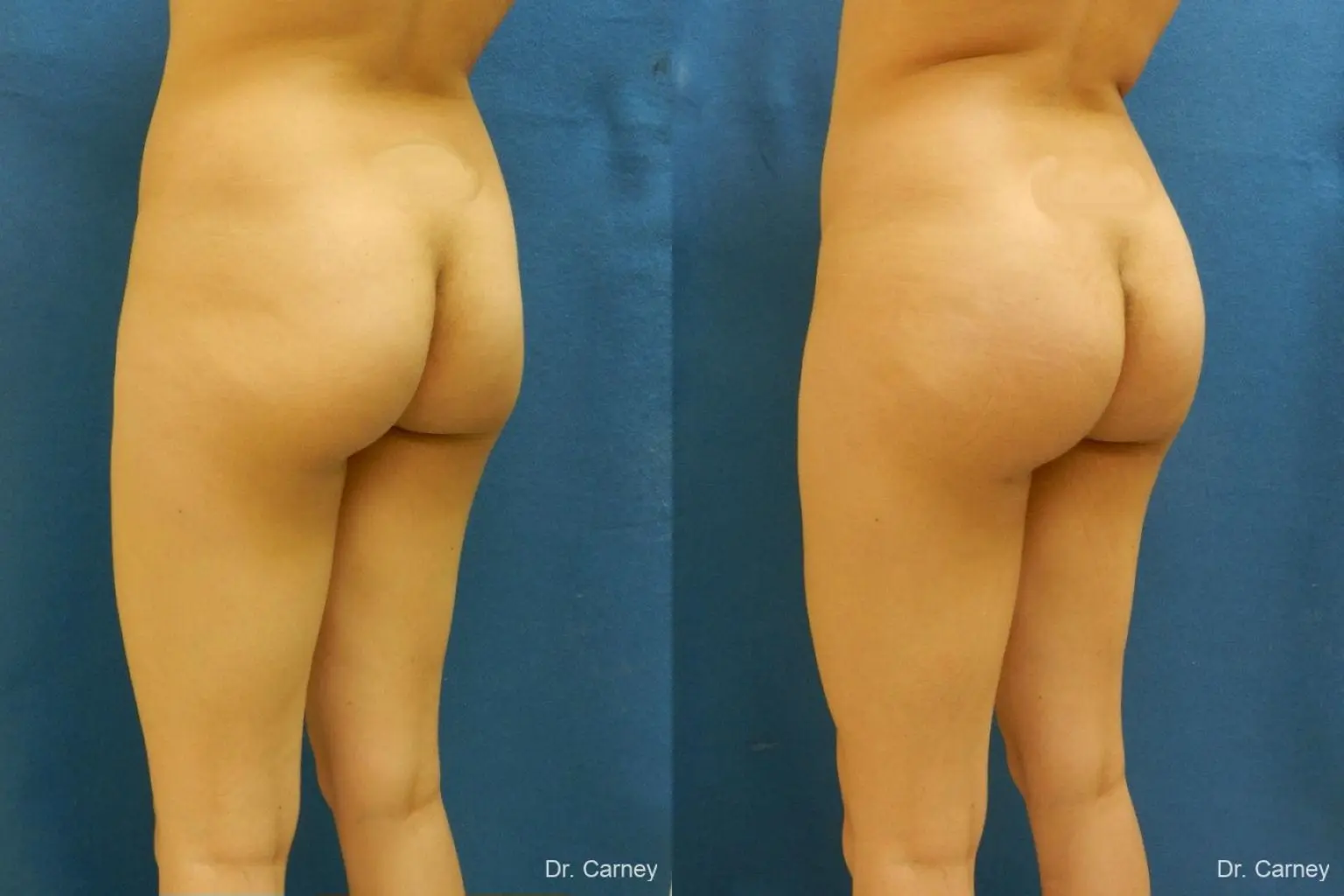 Virginia Beach Brazilian Butt Lift 1221 - Before and After 5