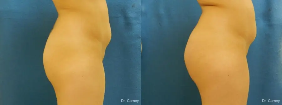 Virginia Beach Brazilian Butt Lift 1221 - Before and After 1