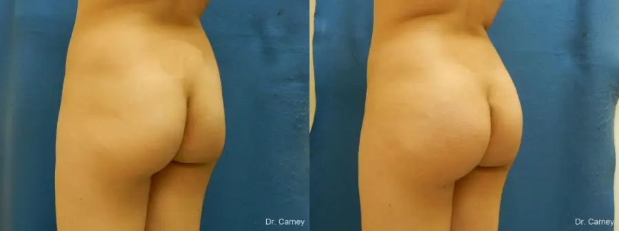 Virginia Beach Brazilian Butt Lift 1221 - Before and After 4
