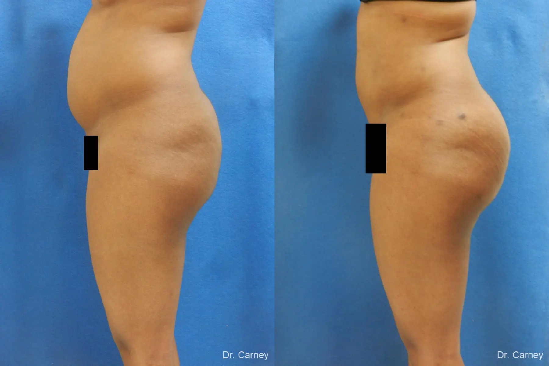 Brazilian Butt Lift: Patient 6 - Before and After  