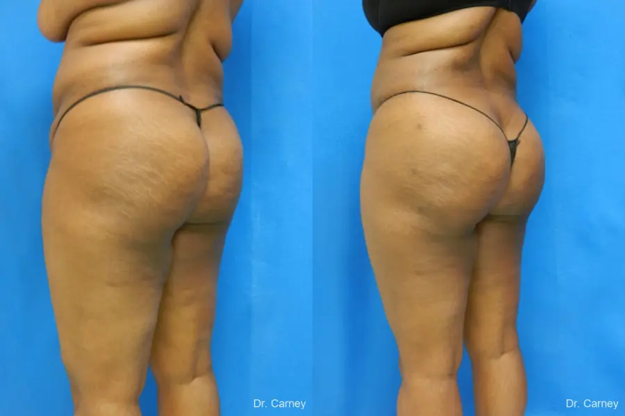 Brazilian Butt Lift: Patient 4 - Before and After 2