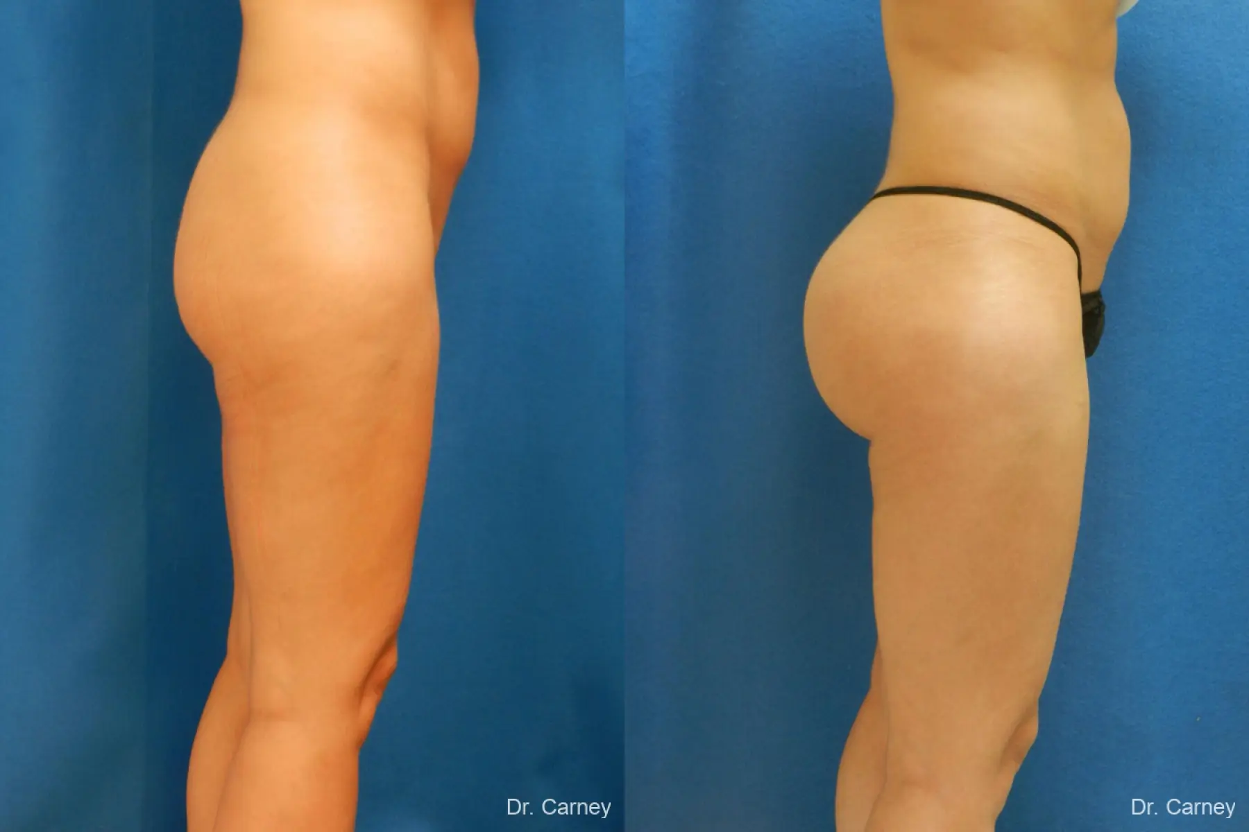 Brazilian Butt Lift: Patient 7 - Before and After  