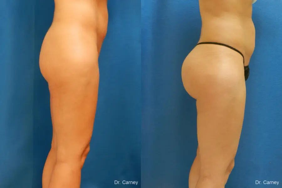 Brazilian Butt Lift: Patient 7 - Before and After 1