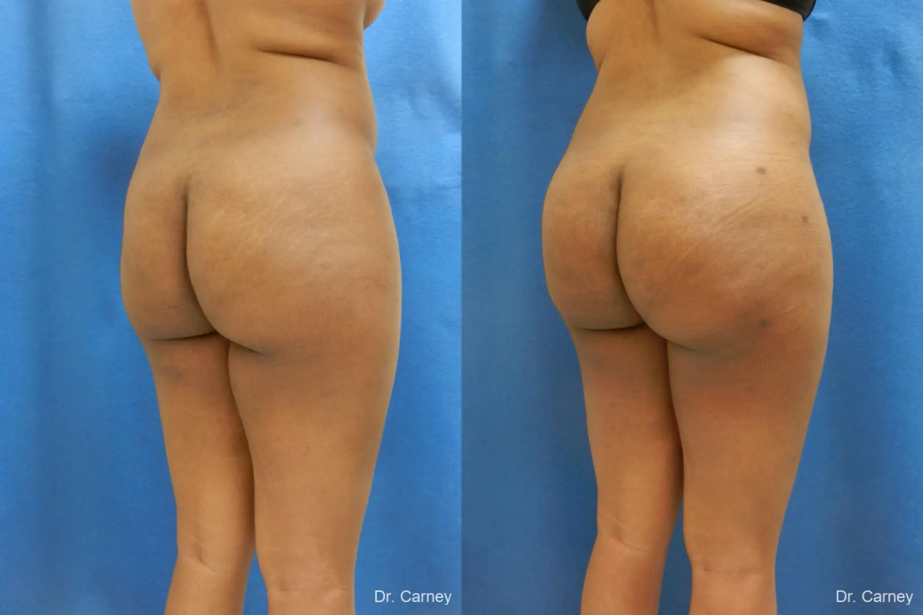 Brazilian Butt Lift: Patient 6 - Before and After 4