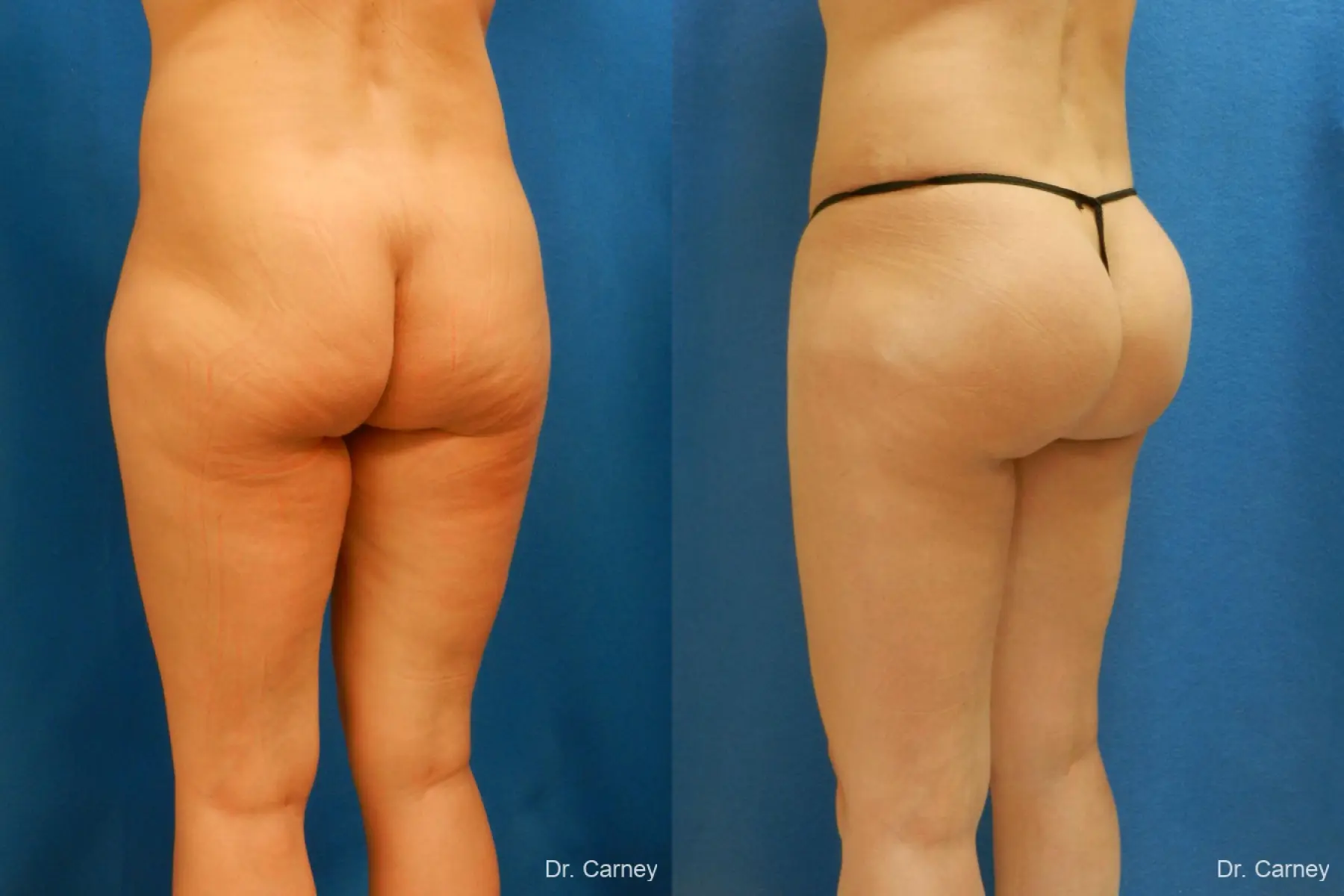 Brazilian Butt Lift: Patient 7 - Before and After 4