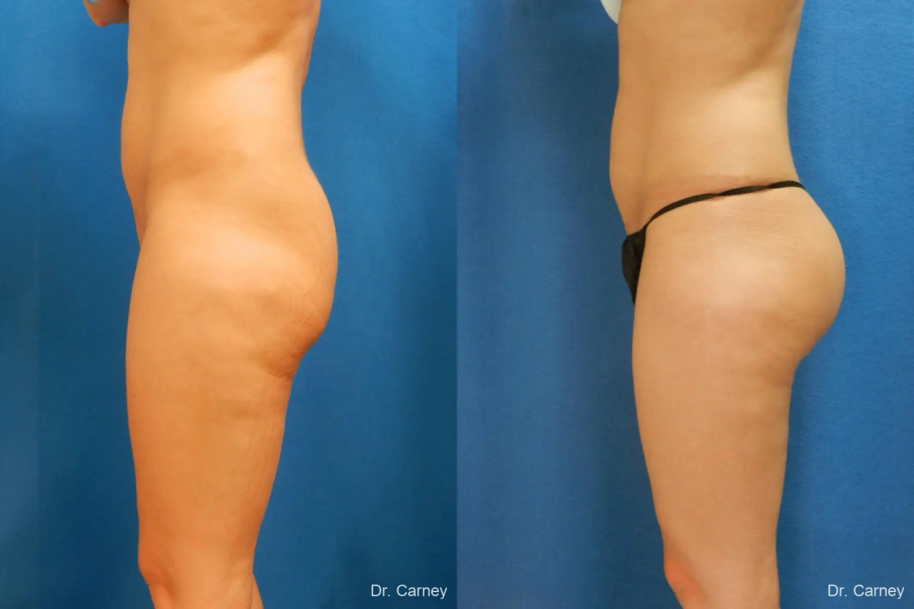 Brazilian Butt Lift: Patient 7 - Before and After 5