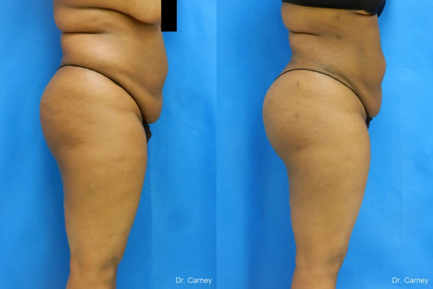 Brazilian Butt Lift: Patient 4 - Before and After 5