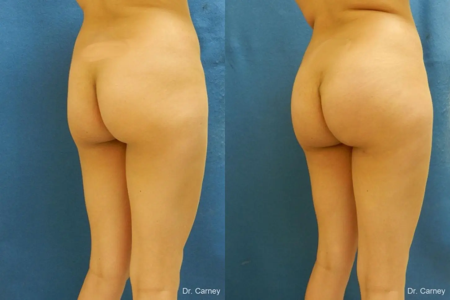 Virginia Beach Brazilian Butt Lift 1221 - Before and After 2