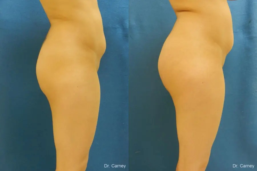 Virginia Beach Brazilian Butt Lift 1221 - Before and After 3