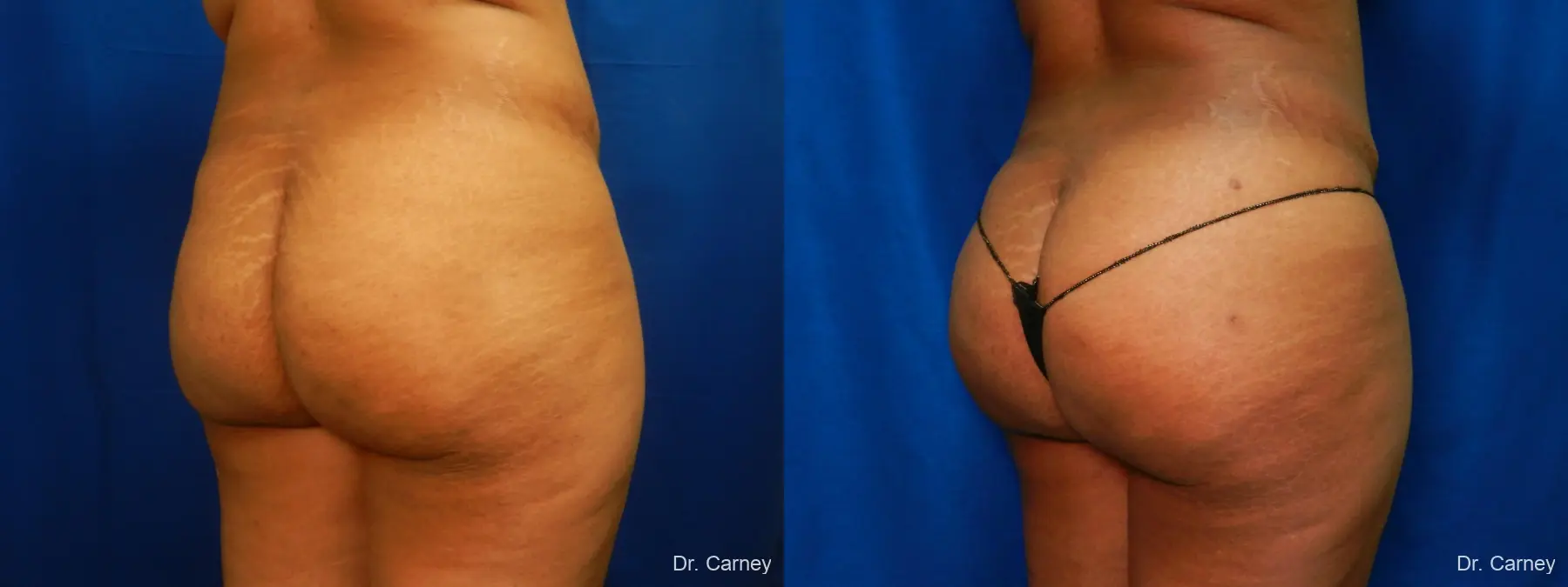 Brazilian Butt Lift: Patient 8 - Before and After  