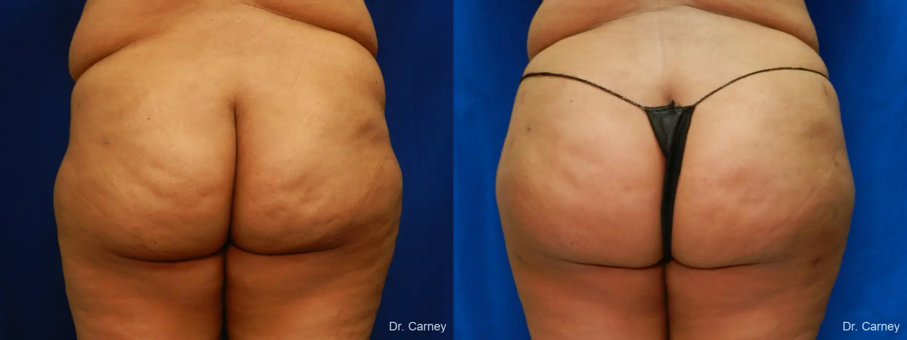 Brazilian Butt Lift: Patient 10 - Before and After  
