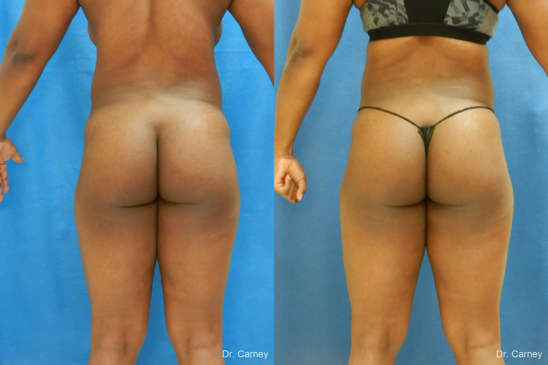 Brazilian Butt Lift: Patient 3 - Before and After 5