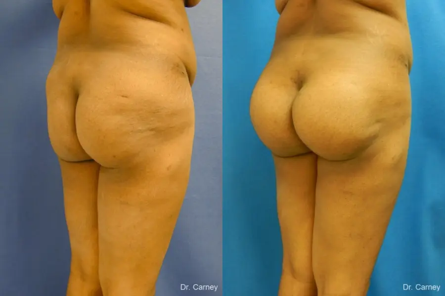 Virginia Beach Brazilian Butt Lift 1220 - Before and After 2