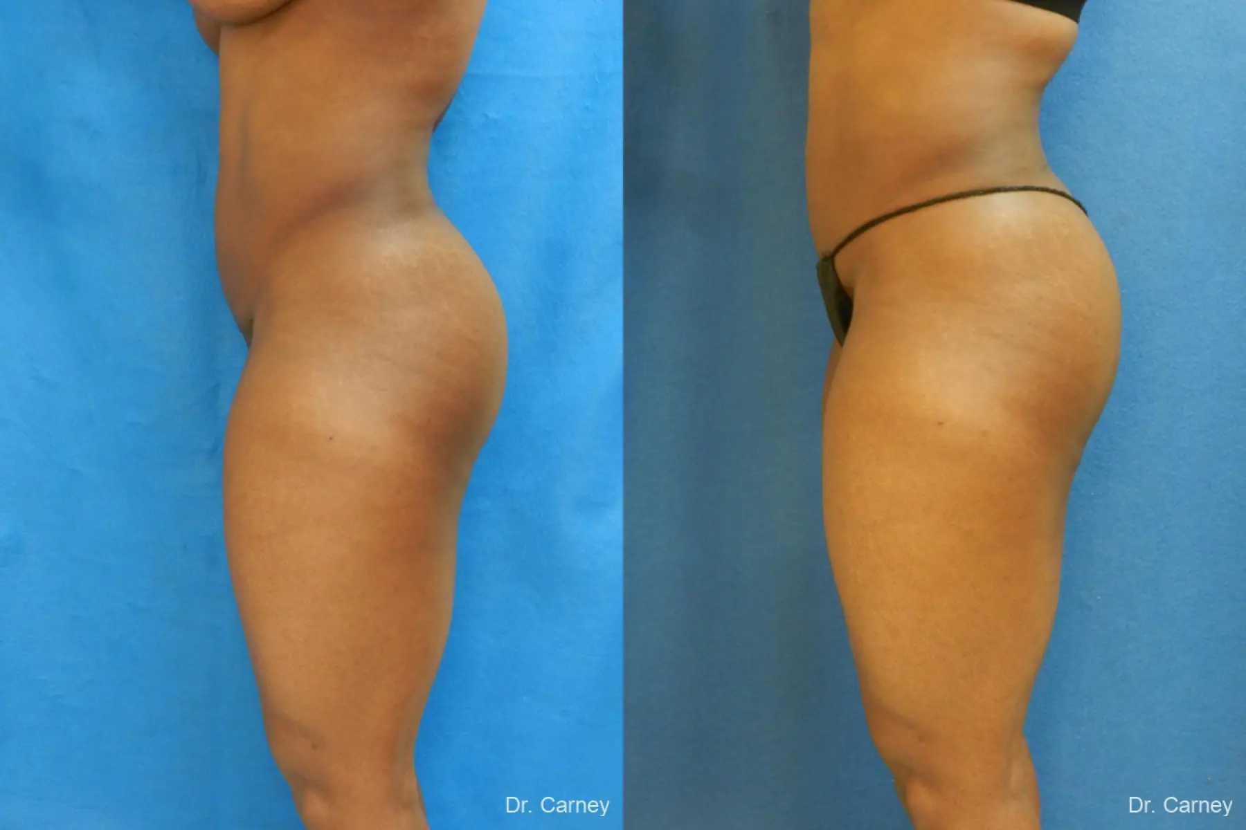 Brazilian Butt Lift: Patient 3 - Before and After 2