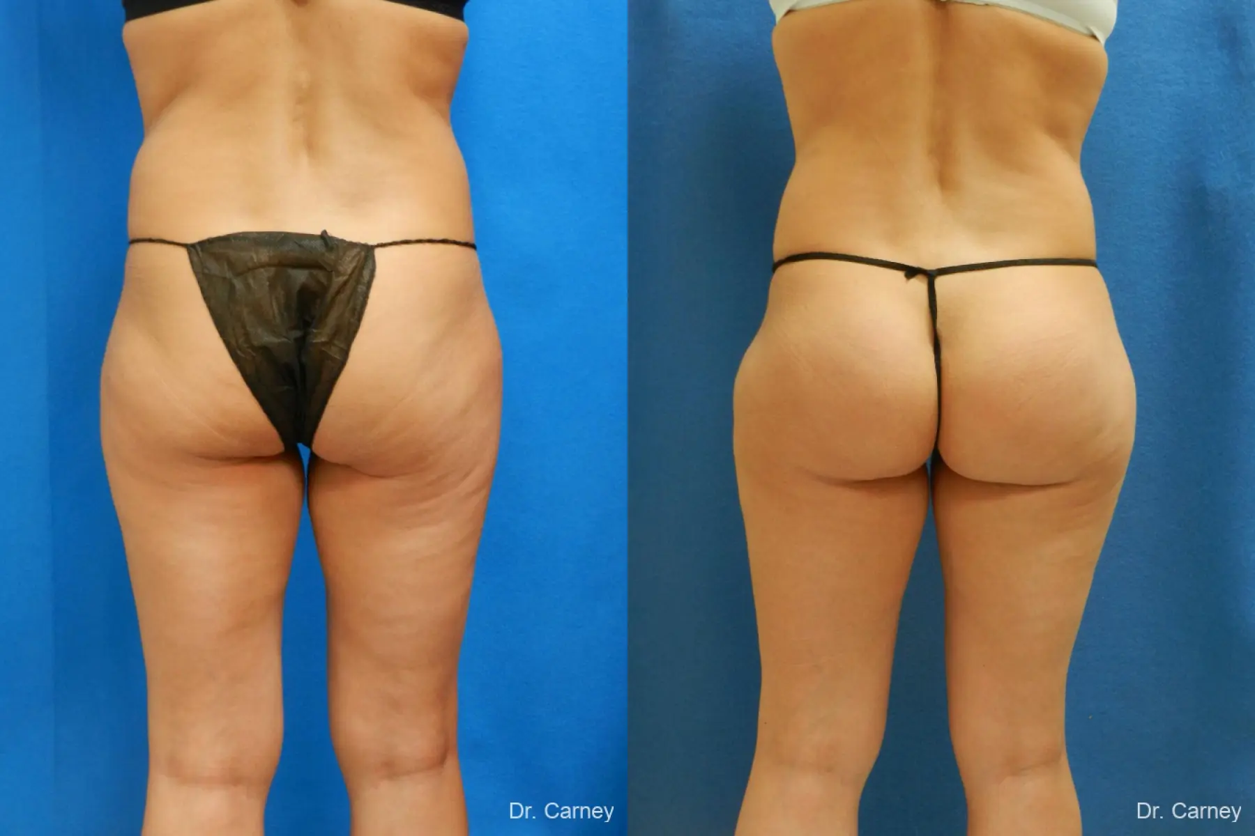 Brazilian Butt Lift: Patient 7 - Before and After 3