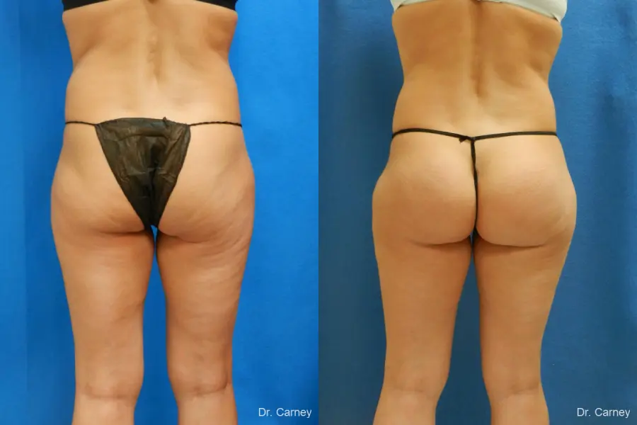 Brazilian Butt Lift: Patient 7 - Before and After 3