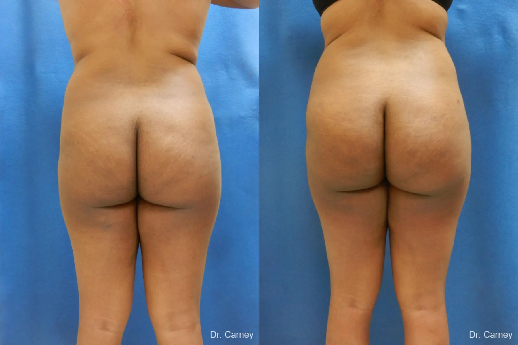 Brazilian Butt Lift: Patient 6 - Before and After 3