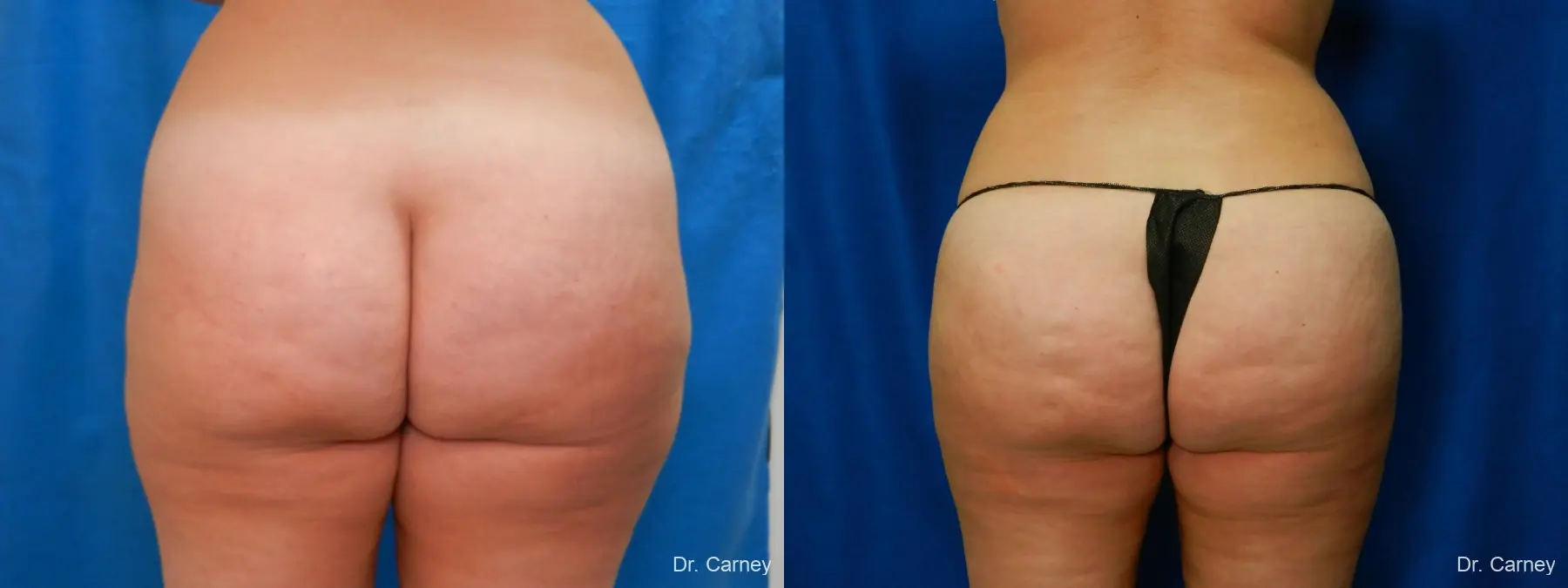 Brazilian Butt Lift: Patient 9 - Before and After  