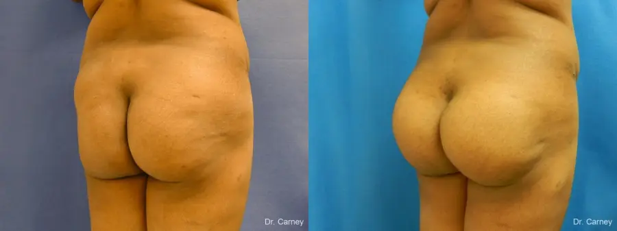 Virginia Beach Brazilian Butt Lift 1220 - Before and After 4