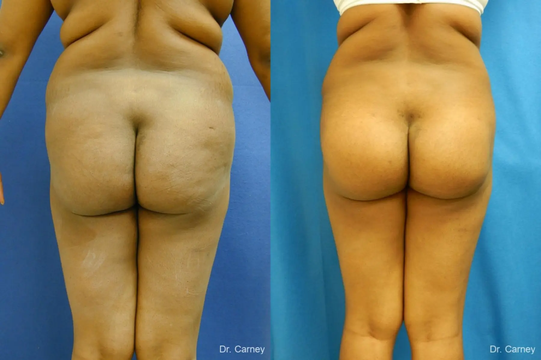 Virginia Beach Brazilian Butt Lift 1220 - Before and After