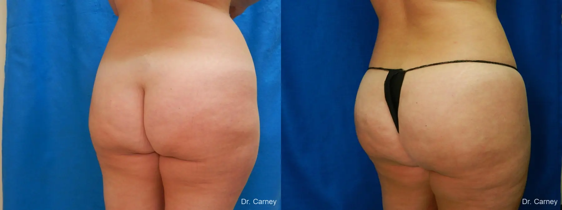Brazilian Butt Lift: Patient 9 - Before and After 2