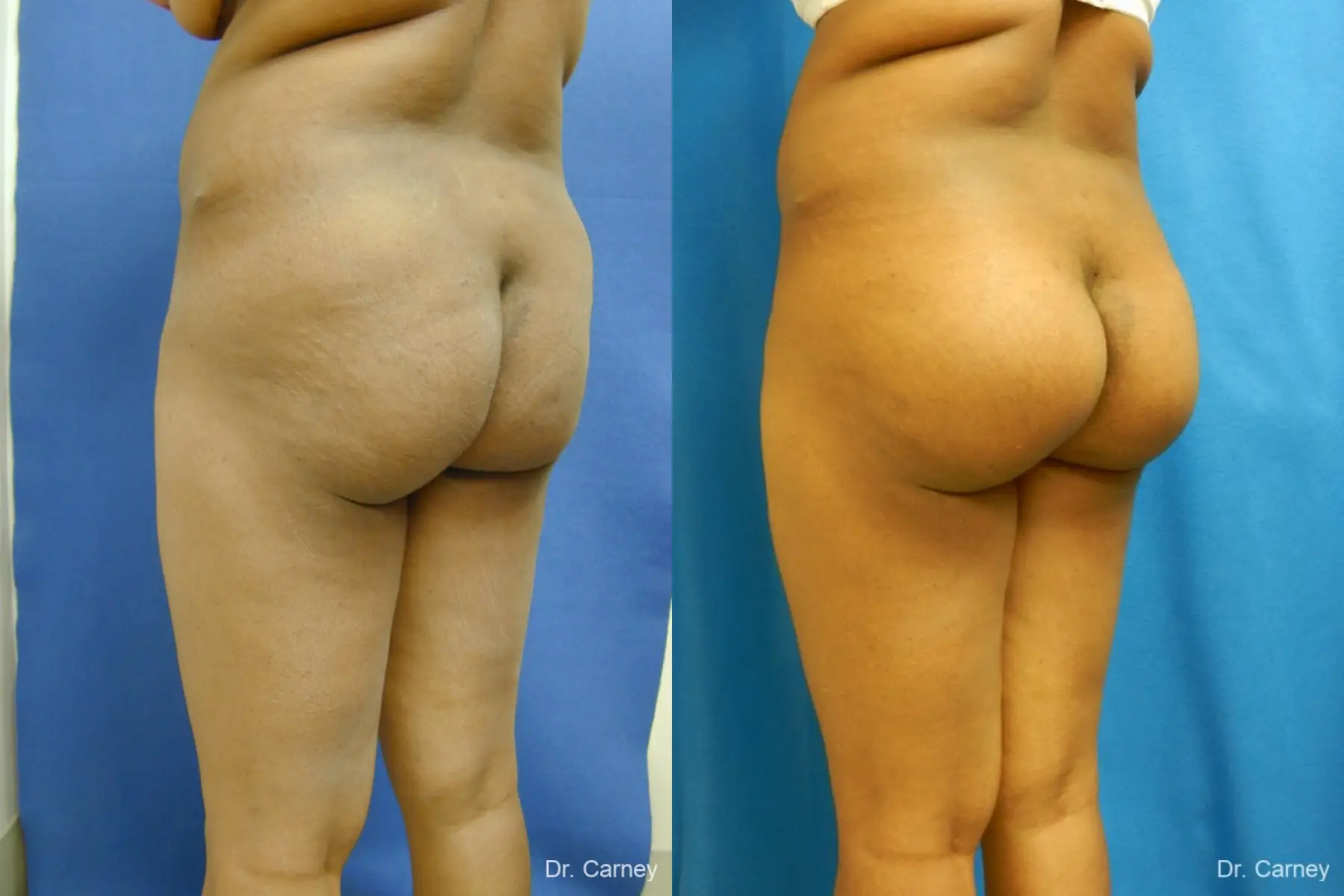 Virginia Beach Brazilian Butt Lift 1220 - Before and After 5