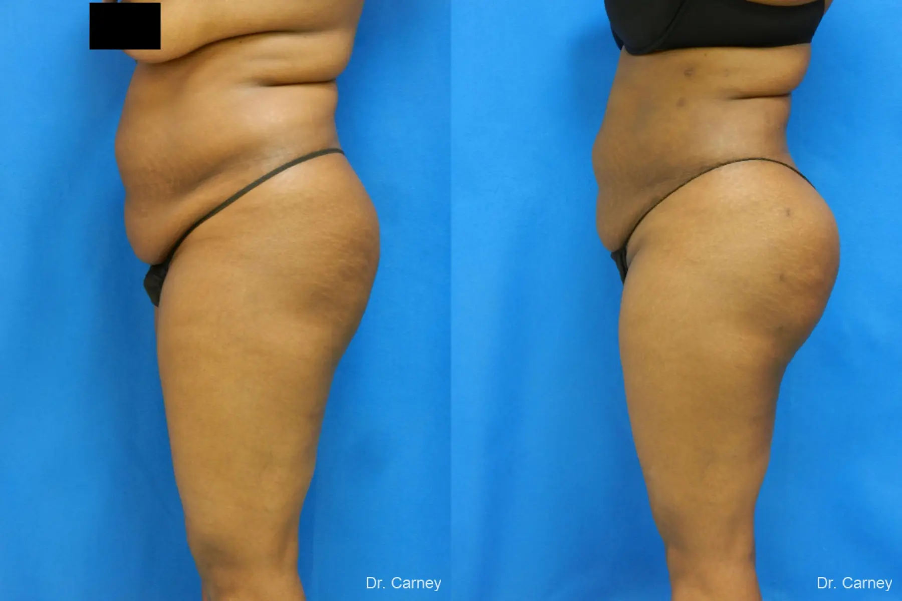 Brazilian Butt Lift: Patient 4 - Before and After  