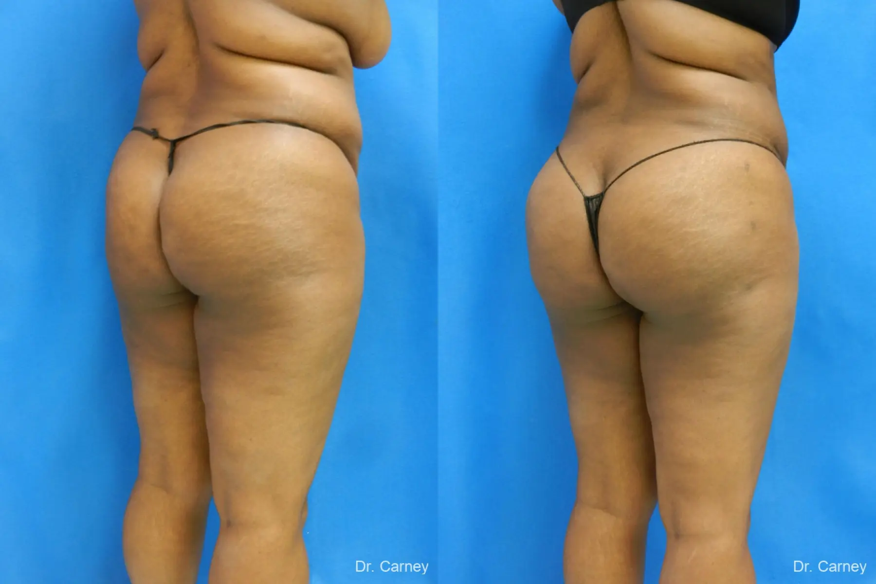 Brazilian Butt Lift: Patient 4 - Before and After 4