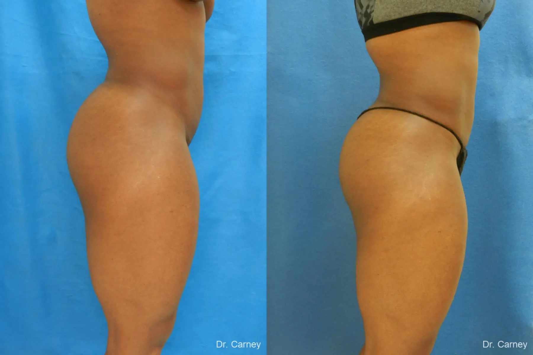 Brazilian Butt Lift: Patient 3 - Before and After  
