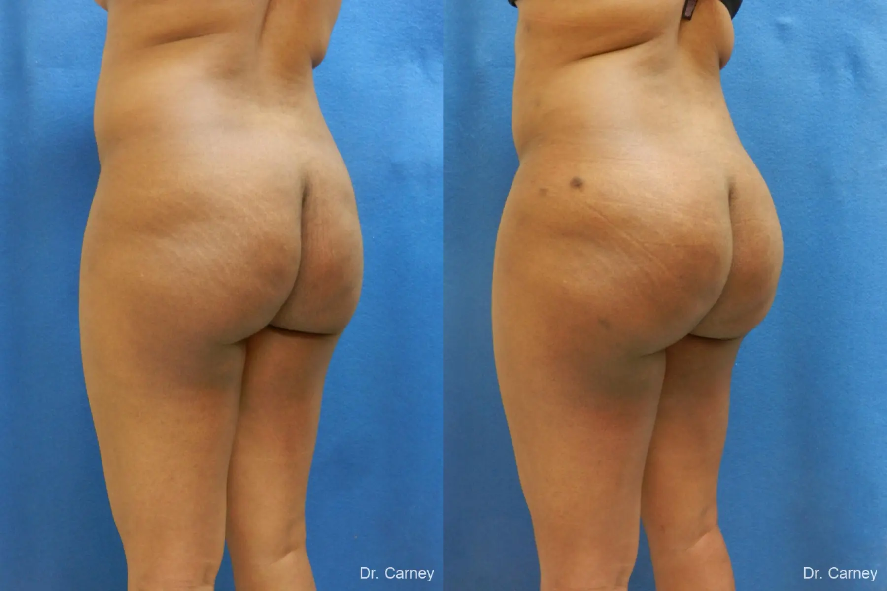 Brazilian Butt Lift: Patient 6 - Before and After 2