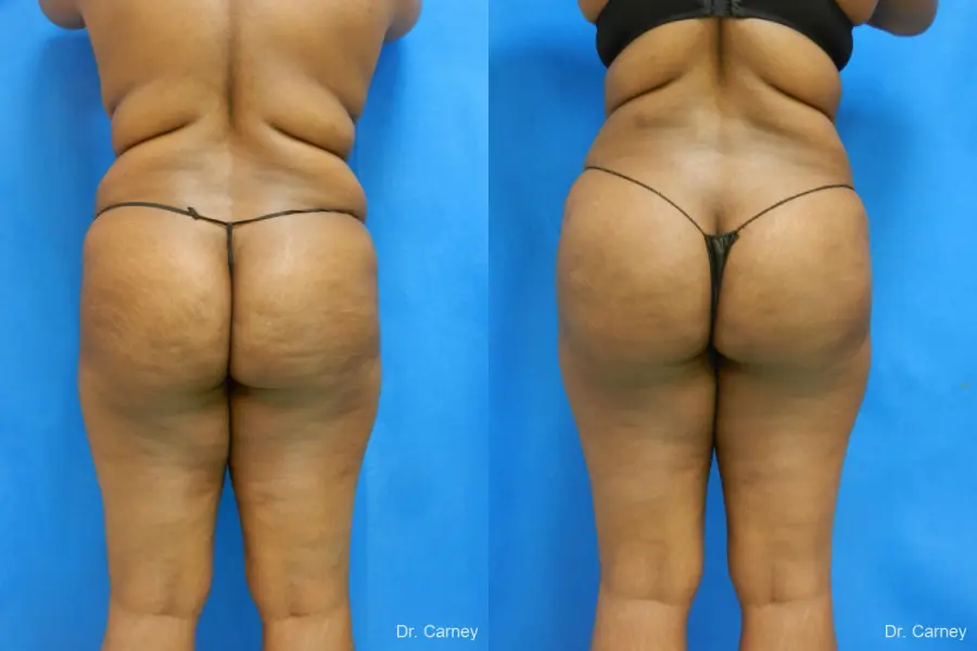 Brazilian Butt Lift: Patient 4 - Before and After 3