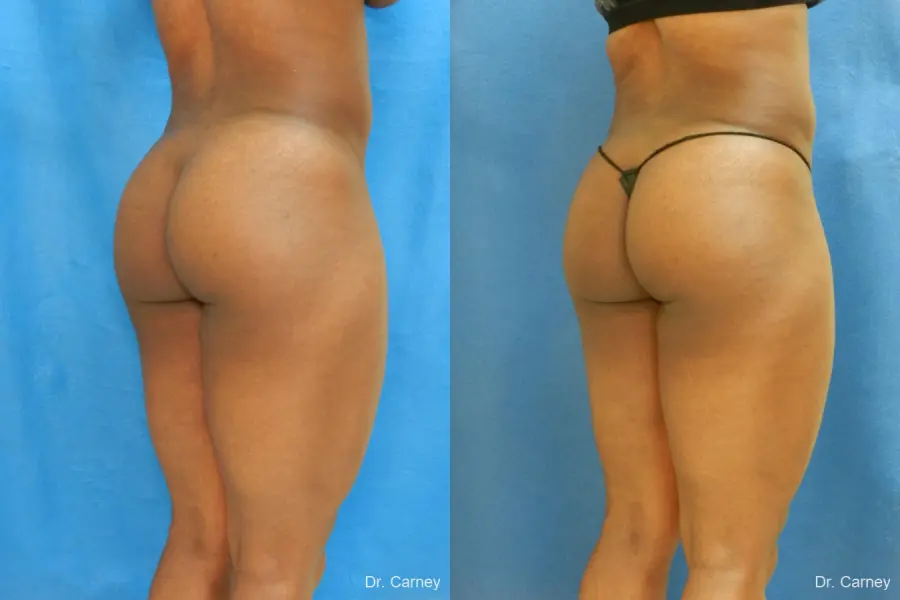 Brazilian Butt Lift: Patient 3 - Before and After 3