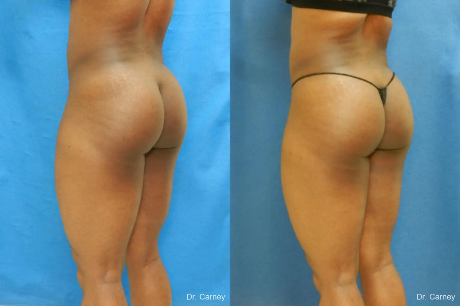 Brazilian Butt Lift: Patient 3 - Before and After 4